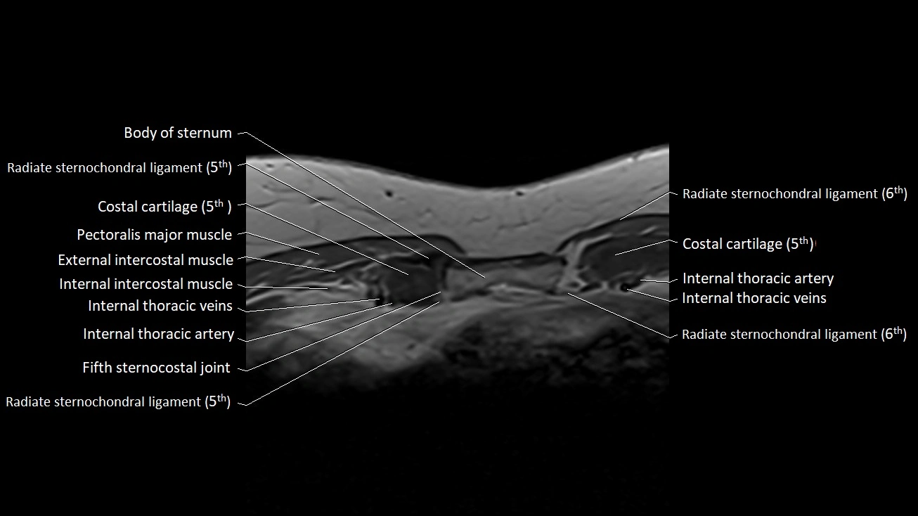 MRI sternum and sternoclavicular joint labeled axial anatomy image 30.webp